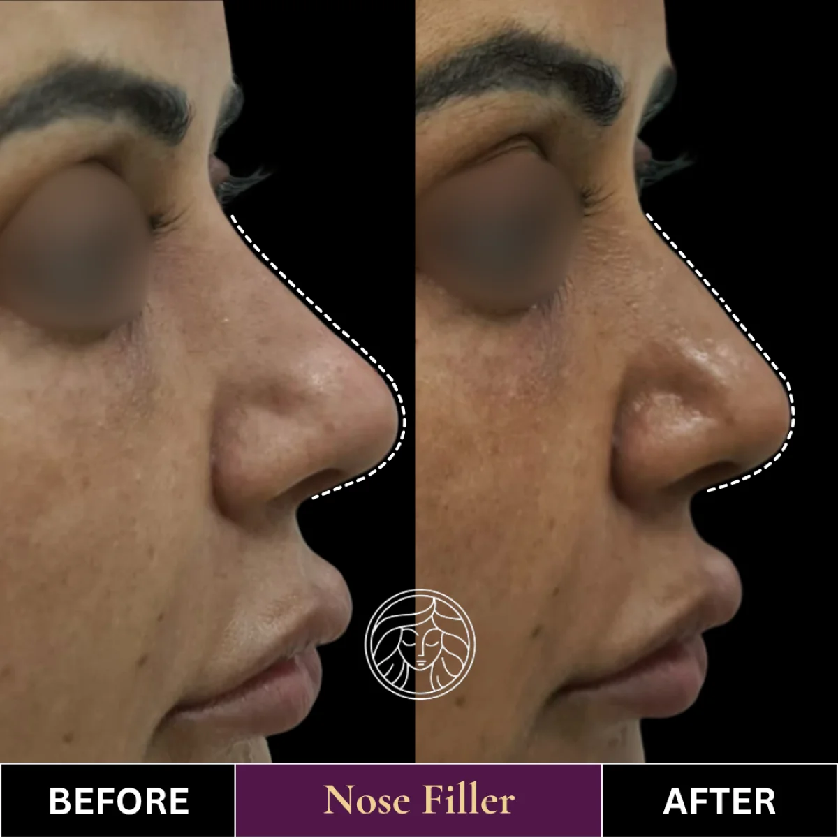 Before and after result 11