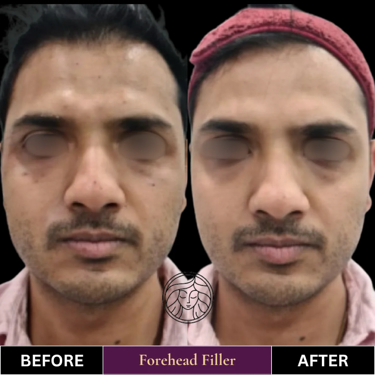 Before and after result 4