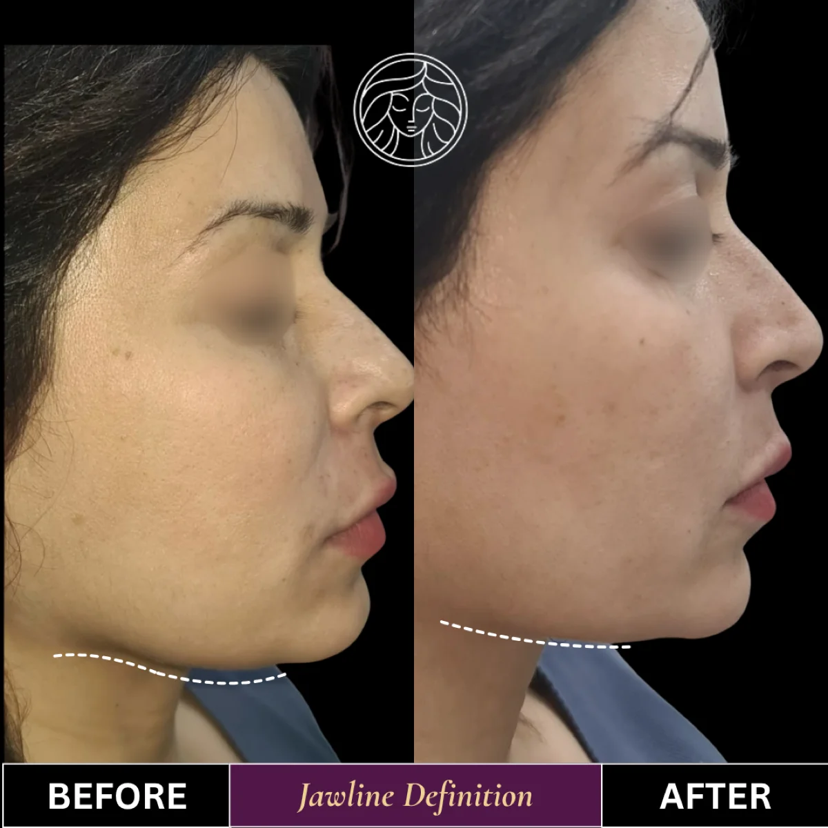 Before and after result 6