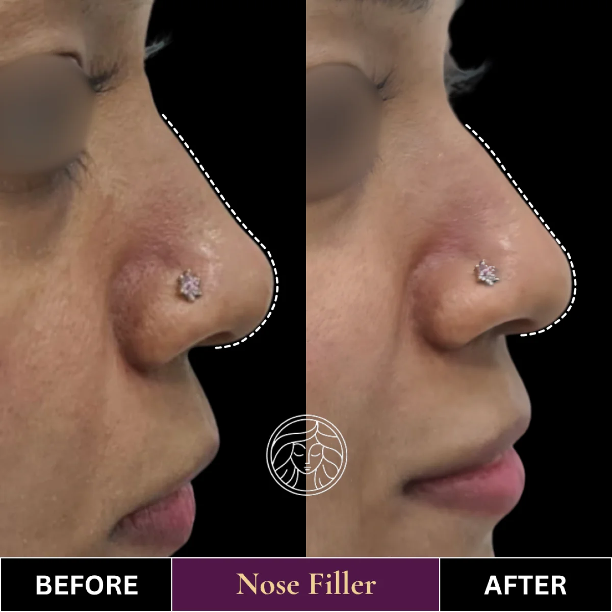 Before and after result 9
